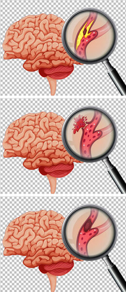 A Set of Human Brain With Stroke illustration