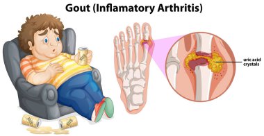 A Fat Man Gout on Foot illustration clipart