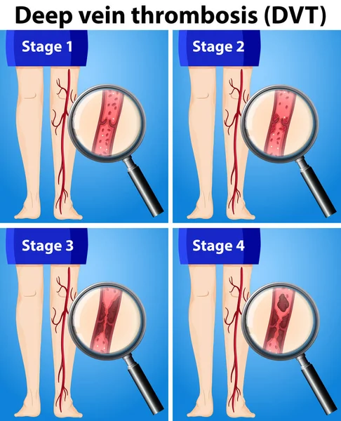 Illustration Des Quatre Étapes Thrombose Veineuse Profonde — Image vectorielle