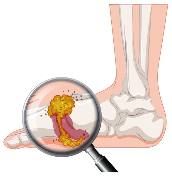 Gout Human Foot Illustration — Stock Vector