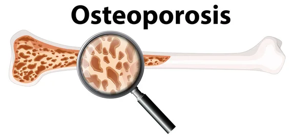 Illustration Ostéoporose Verre Grossissant — Image vectorielle