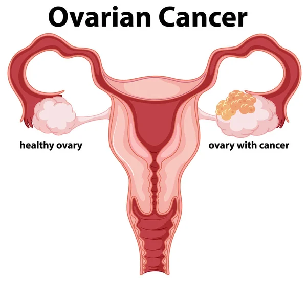 Иллюстрация Концепции Женского Рака Яичников — стоковый вектор