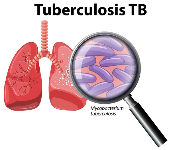 Человеческое Легкое Иллюстрацией Туберкулёзу — стоковый вектор
