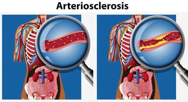 Ilustración Anatomía Humana Con Arteriosclerosis — Vector de stock