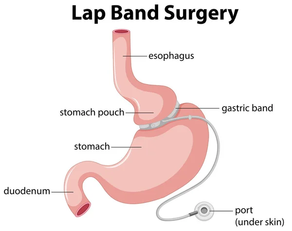 Ilustrasi Lap Band Surgery Diagram - Stok Vektor