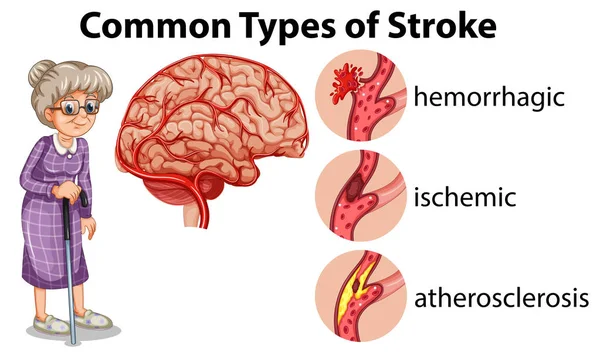 Common Types Stroke Illustration — Stock Vector