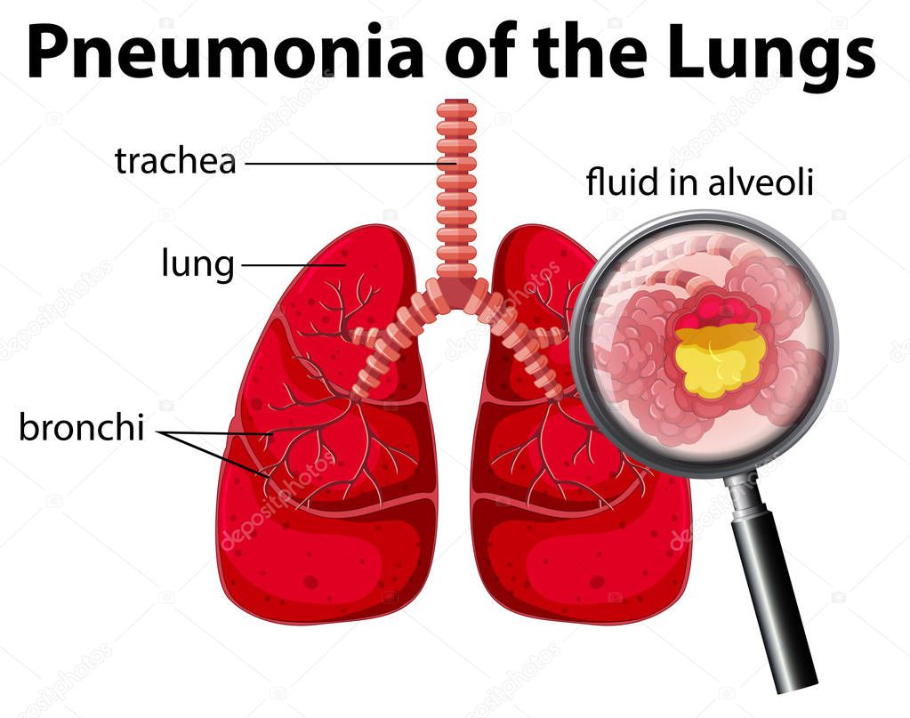 Pneumonia of the Lungs Diagram illustration