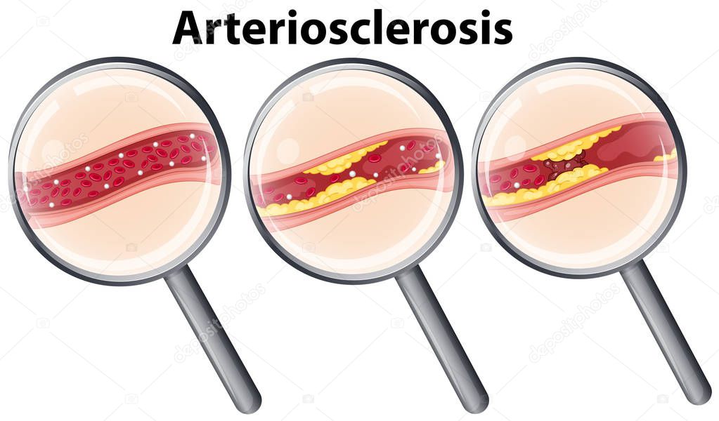 Human with Arteriosclerosis magnified illustration