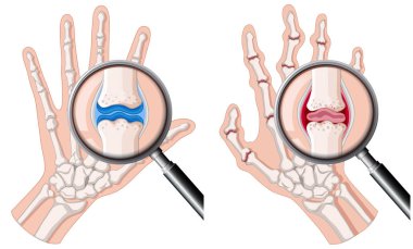 A human hand with rheumatoid arthritis illustration clipart