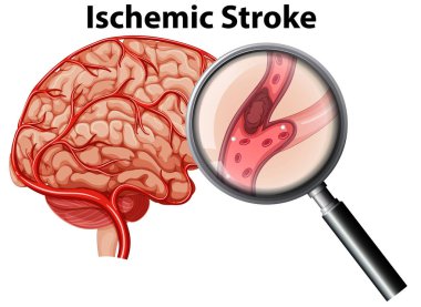 Magnified Ischemic stroke concept illustration clipart