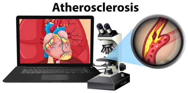 Aterosclerosis Portátil Microscopio Concepto Ilustración — Vector de stock