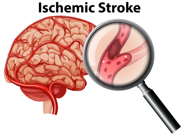 Magnified Ischemic Stroke Concept Illustration — Stock Vector