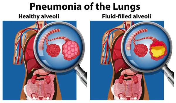 Pneumonia Lungs Concept Illustration — Stock Vector