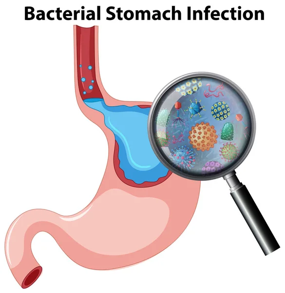 Illustrazione Dell Infezione Batterica Dello Stomaco Anatomia — Vettoriale Stock