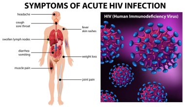 Akut HIV enfeksiyonu illüstrasyon belirtileri