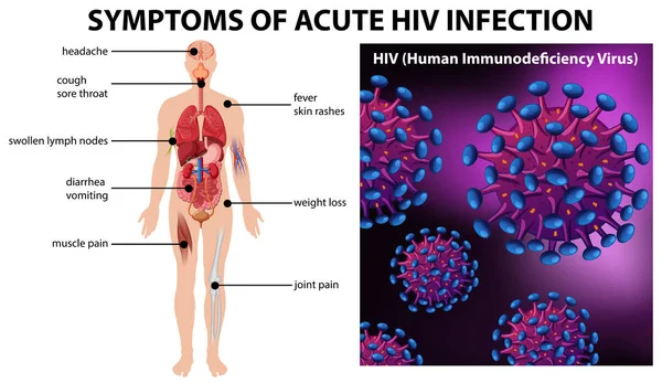 Akut Hiv Enfeksiyonu Illüstrasyon Belirtileri — Stok Vektör