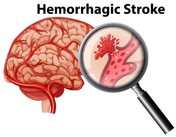 Een Menselijke Anatomie Hemorragische Beroerte Illustratie — Stockvector