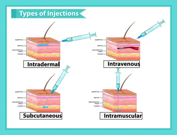 Wissenschaftliche medizinische Illustration der Arten von Injektionen — Stockvektor