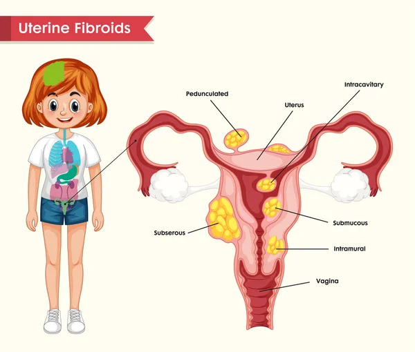 Ilustração médica científica de miomas uterinos — Vetor de Stock