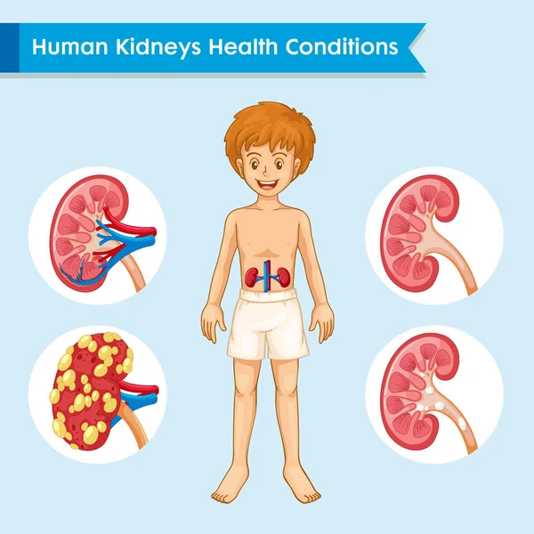 Scientific medical illustration of kidney disease — Stock Vector