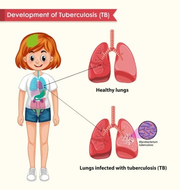 Tüberküloz bilimsel tıbbi Illustration