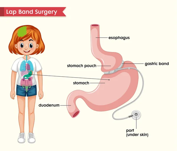 Wetenschappelijke medische illustratie van schoot band proces — Stockvector