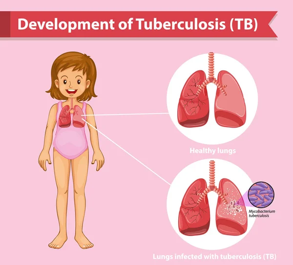 Wetenschappelijke medische illustratie van tuberculose TB — Stockvector
