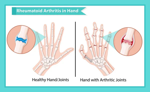 Wissenschaftliche medizinische Illustration der rheumatoiden Arthritis — Stockvektor