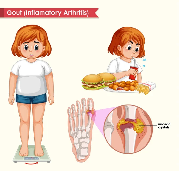 Ilustração médica científica do conceito de gota — Vetor de Stock