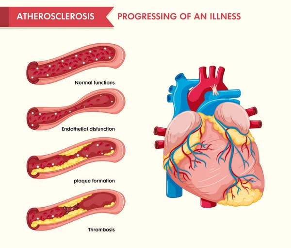 Ilustración médica científica de la aterosclerosis — Vector de stock