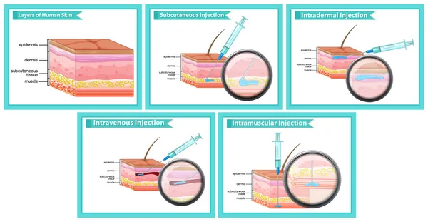 Illustration médicale scientifique des types d'injections — Image vectorielle