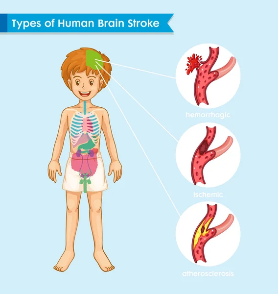 Ilustración médica científica del concepto de accidente cerebrovascular — Archivo Imágenes Vectoriales