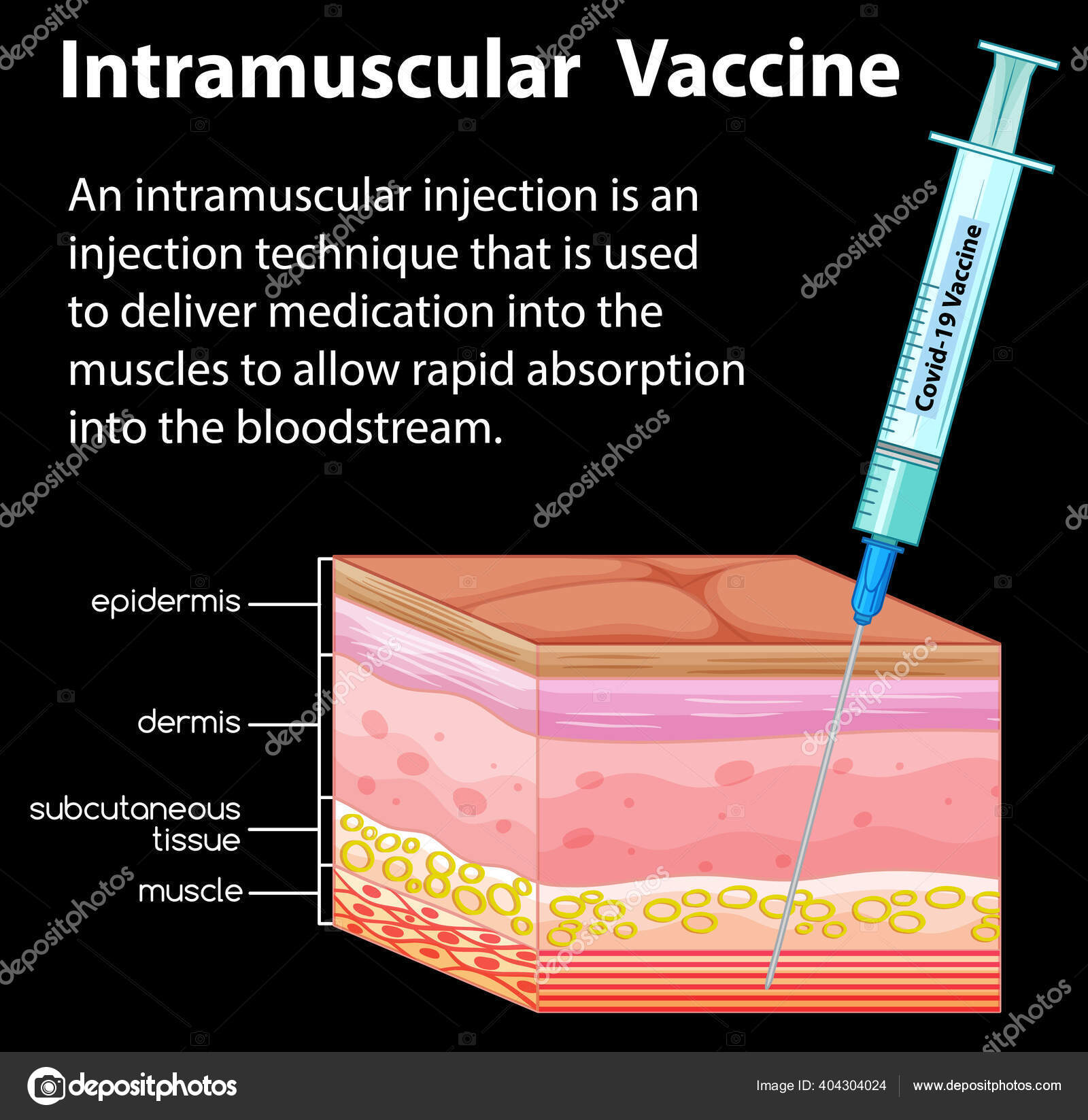 vastus lateralis injection