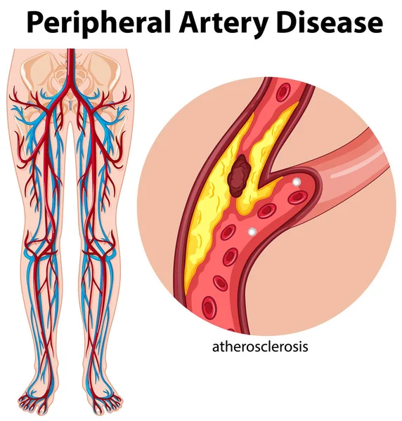 Enfermedad Arterial Periférica Médica Ilustración — Vector de stock