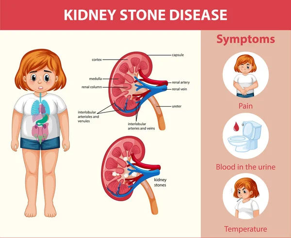 Ledvinové Kameny Nemoc Karikatura Styl Infographic Ilustrace — Stockový vektor