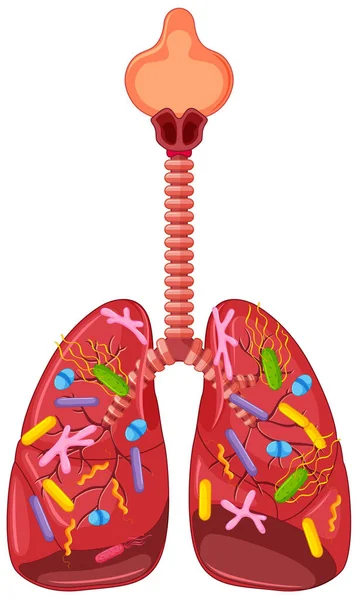 Infección Pulmonar Bacteriana Anatomía Ilustración — Vector de stock