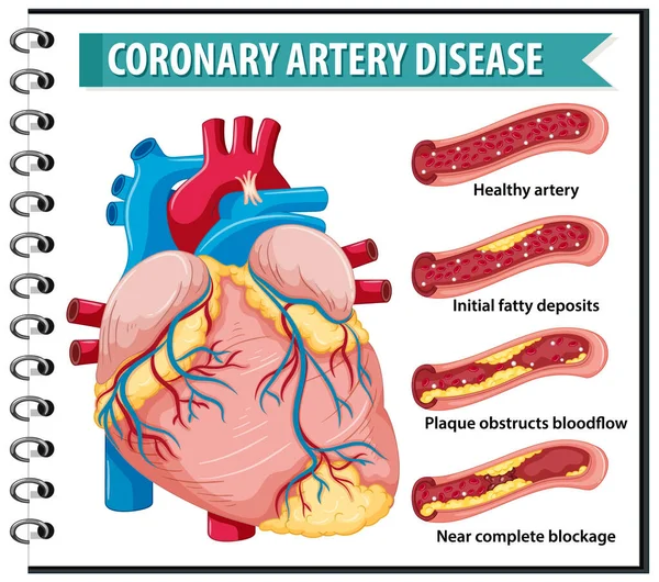 Coronaire Hartziekte Voor Gezondheidseducatie Infografische Illustratie — Stockvector