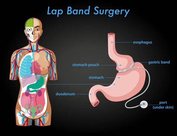 Lap Band Chirurgie Anatomie Illustratie — Stockvector