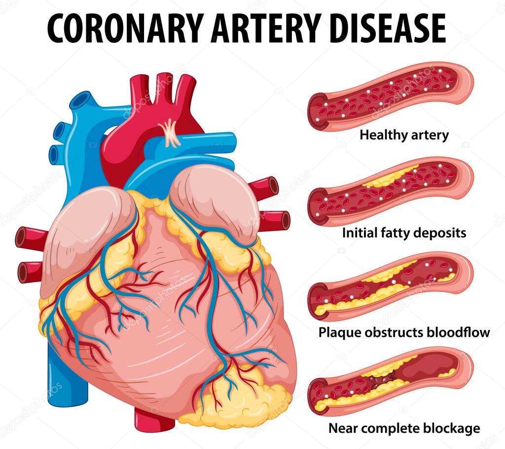 Coronary Artery Disease for health education Infographic illustration