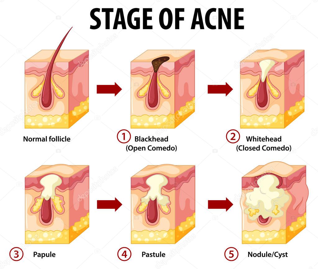 Stages of skin acne anatomy illustration