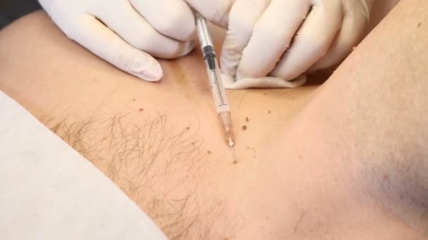 Extracción de papilomas. De cerca. Médico extirpando lunar en el procedimiento quirúrgico quemándolo con herramientas médicas y equipo en el cuerpo masculino — Vídeos de Stock