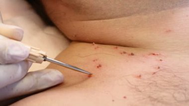 Cerrahi kavramı. Papillomas kaldırma. Yakın çekim. Doktor tıbbi araç ve ekipman erkek vücudunda yakarak cerrahi prosedürde mol kaldırma