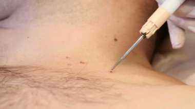 Cerrahi kavramı. Papillomas kaldırma. Yakın çekim. Doktor tıbbi araç ve ekipman erkek vücudunda yakarak cerrahi prosedürde mol kaldırma