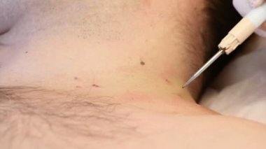 Cerrahi kavramı. Papillomas kaldırma. Yakın çekim. Doktor tıbbi araç ve ekipman erkek vücudunda yakarak cerrahi prosedürde mol kaldırma