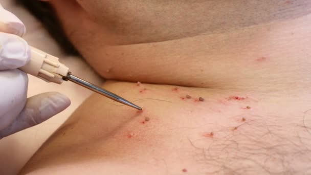 Concetto di chirurgia. Rimozione papillomi. Chiudete. Medico rimozione talpa nella procedura chirurgica bruciandolo con strumenti medici e attrezzature sul corpo maschile — Video Stock