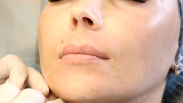 Lips enhancement procedure. Anti-aging injections. Close up of middle-aged woman in beauty clinic. Beautician hands with cannula needle. 4k — Stock Video