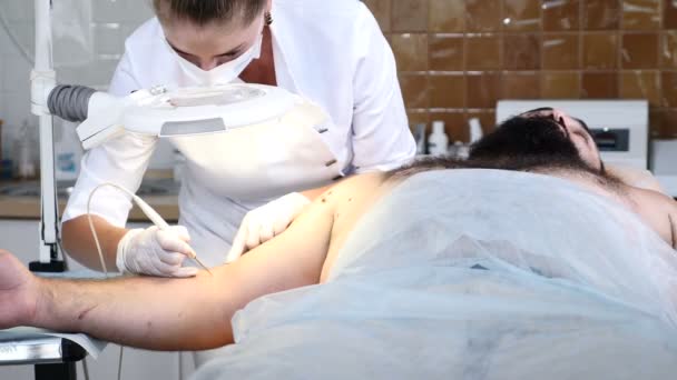 Medico dermatologo in clinica rendendo elettrocoagulazione paziente maschile. rimuovere talpa o papillona. 4 k — Video Stock