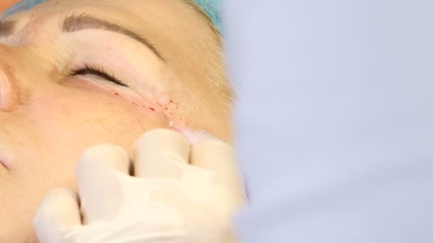 Инъекции мезотерапии. Старушке делают операцию на лице. Профессиональный косметолог со шприцем в руках, делающий инъекции красоты . — стоковое видео