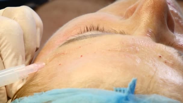 Frau in ihren 60ern bekommt Gesichtsbehandlung. Mesotherapie und Botox-Injektion. Kosmetikerin bei der Arbeit. hd — Stockvideo