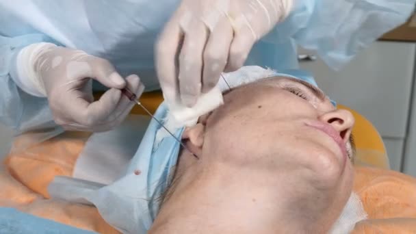 Koncepcja kosmetologii. Strzał zbliżenie chirurga ręce w rękawiczkach, dzięki czemu skóra twarz bolesne procedury podnoszenia. Kontur twarzy, tworząc z cog wątków. 4k — Wideo stockowe